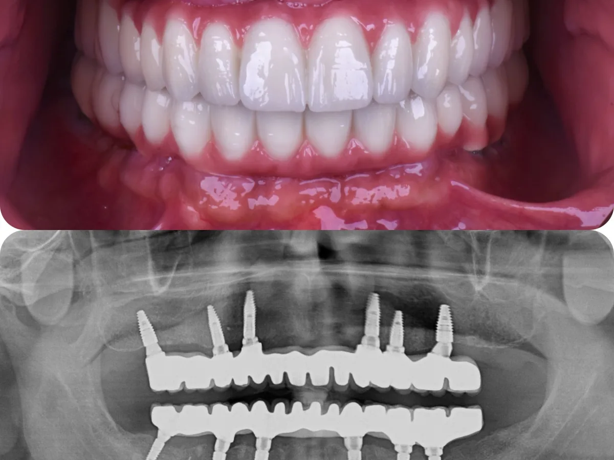 All-on-6 implant üzerine uygulanan zirkonyum protez örneği