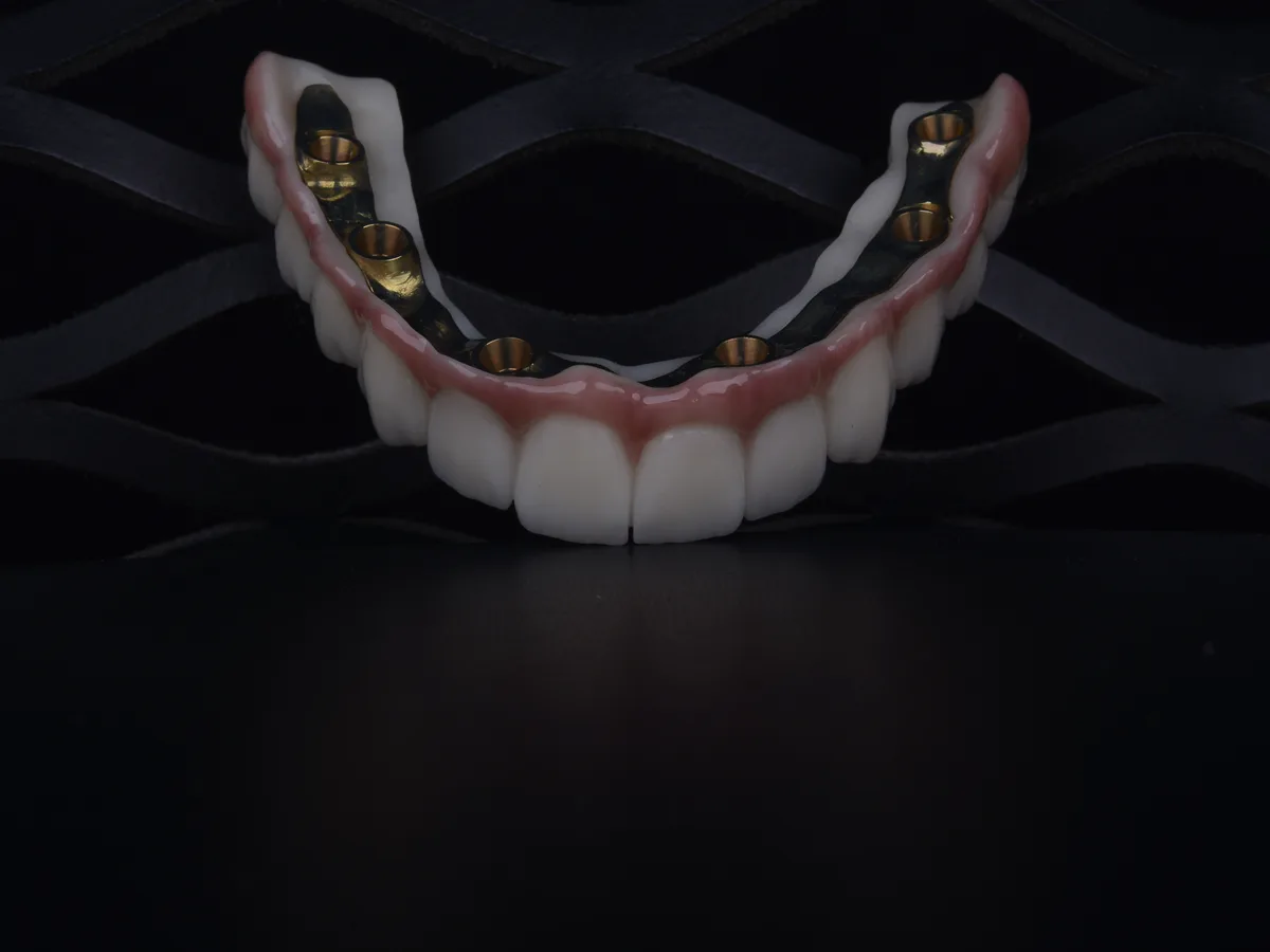 All-on-6 implant sonrası sabit protez ile elde edilen gülüş sonucu