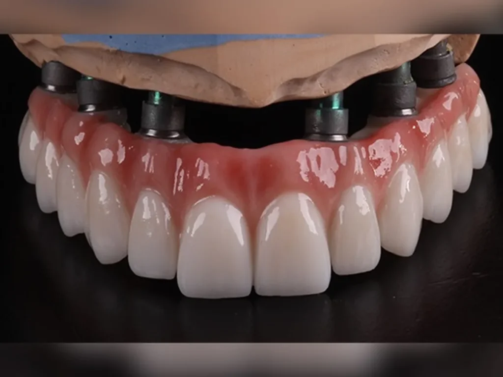 Altı titanyum implantın çene kemiğine yerleştirilmesini gösteren all-on-6 implant şeması