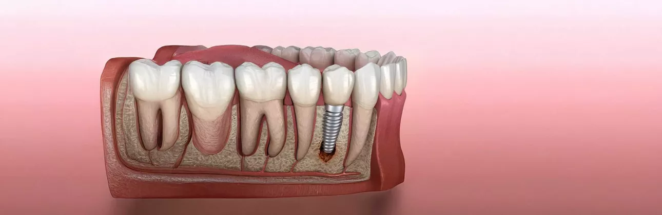 Failed dental implant evaluation at Citydent Istanbul dental clinic