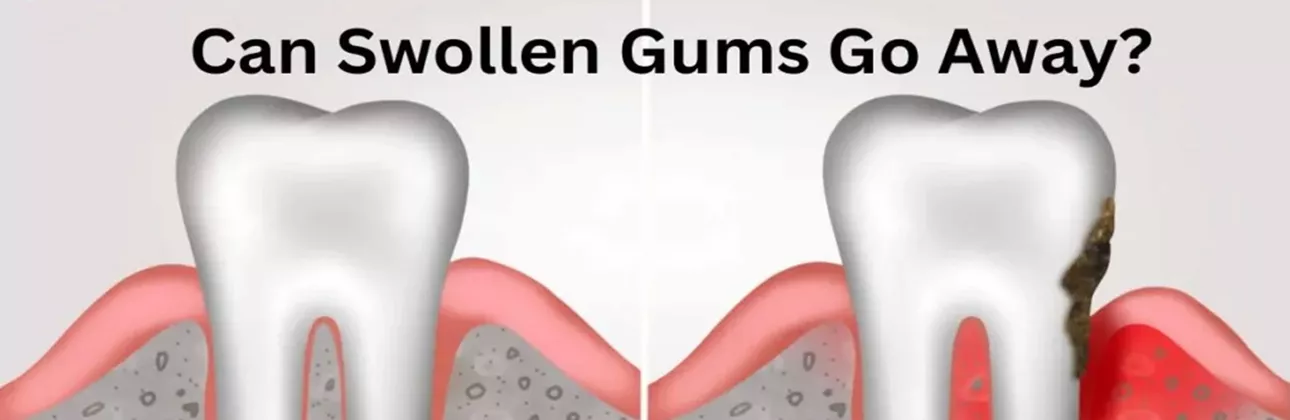 Swollen gum tissue — clinical close-up showing gum inflammation around the tooth and gum line