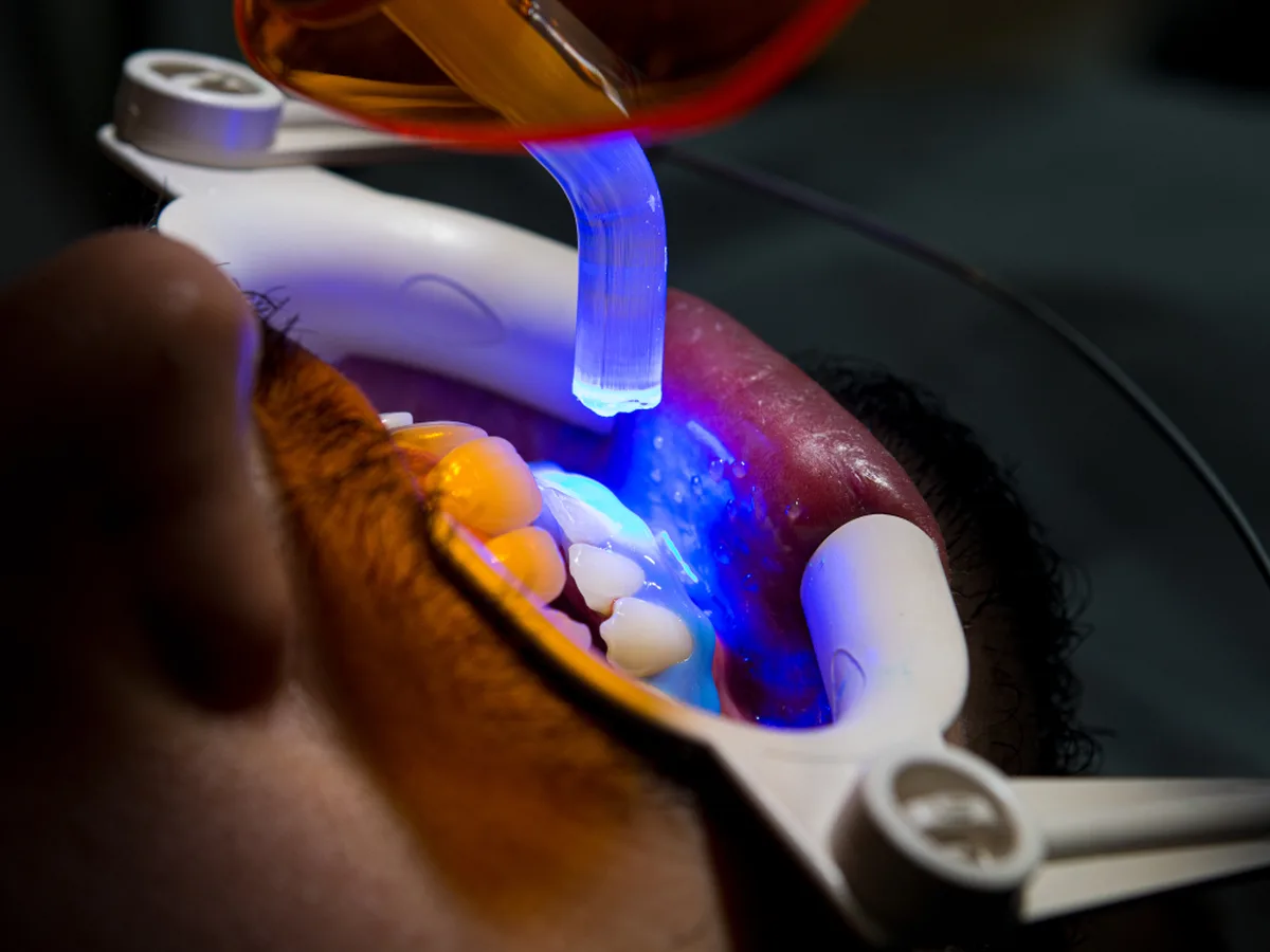 BL1 BL2 BL3 BL4 bleaching shade chart — teeth whitening Istanbul
