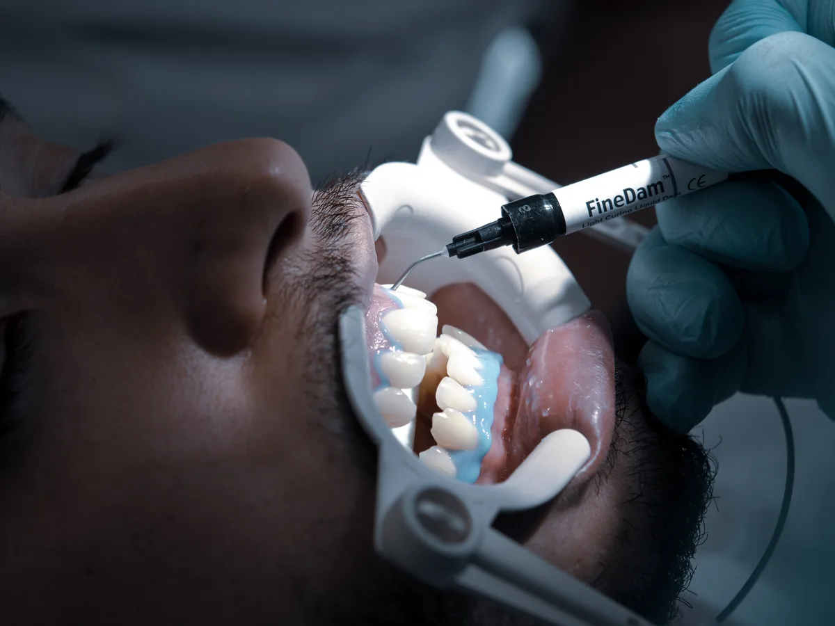 In-clinic versus at-home teeth whitening comparison — CityDent Istanbul