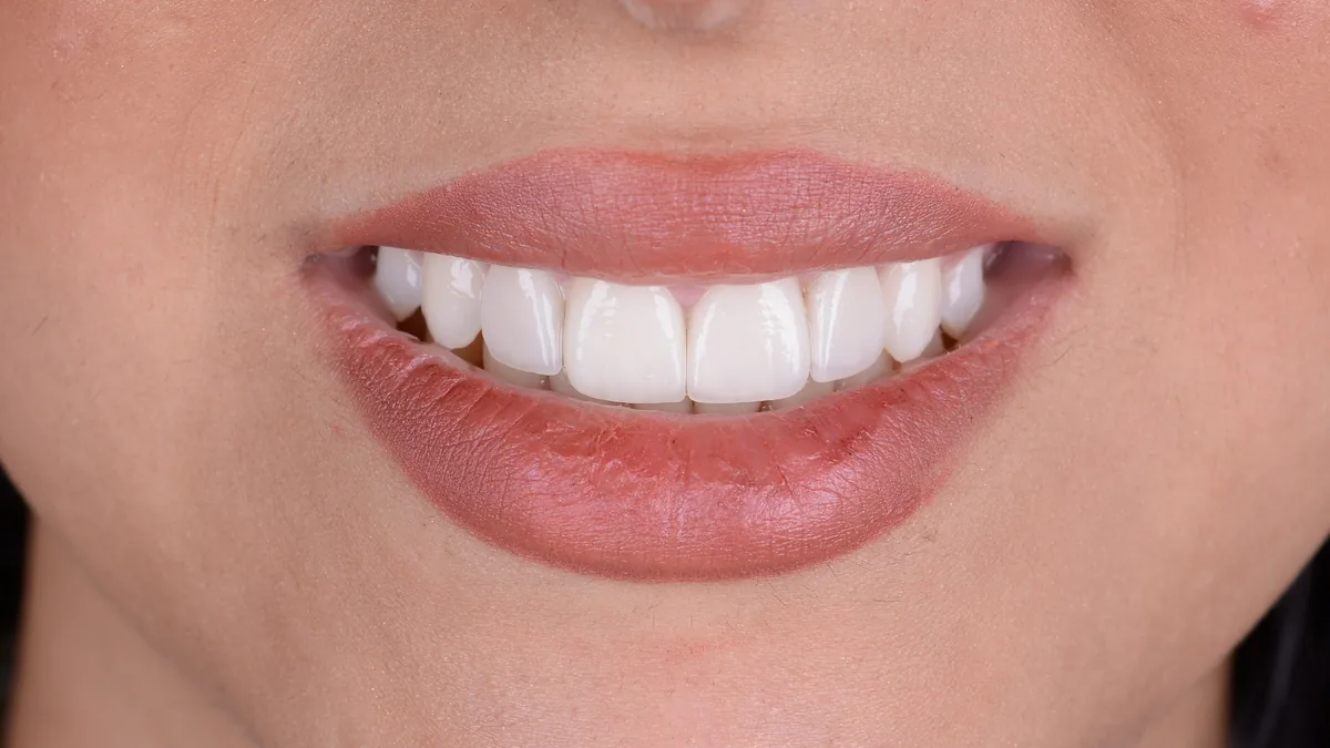 Veneer-Beratung f&uuml;r internationale Patienten bei CityDent Istanbul