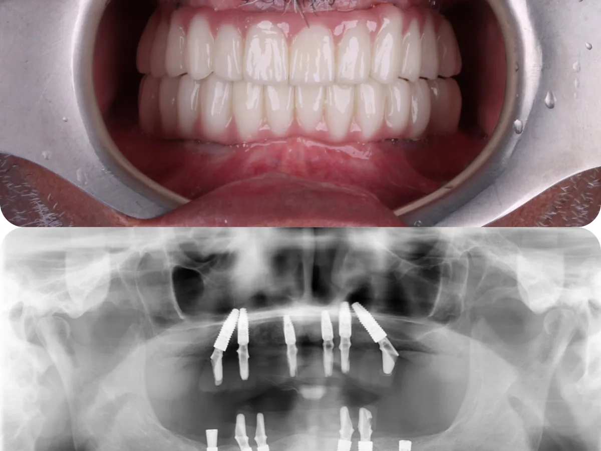 Tüm ağız implant tedavisinde çene modeli üzerinde implant ve sabit protez planlaması