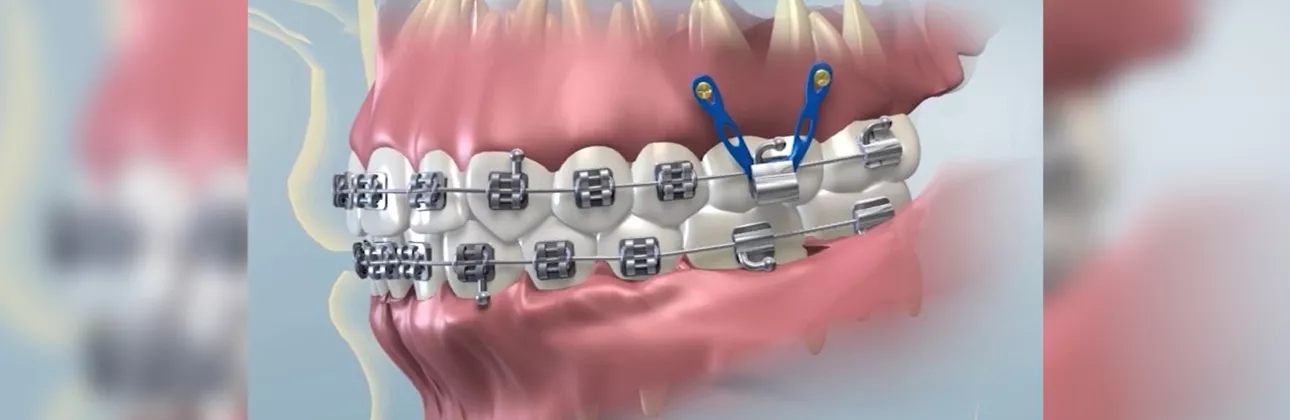 Orthodontic implant Istanbul – mini implant and TAD anchorage procedure at Citydent