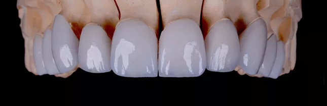 Fixed dental crowns — precision-fitted zirconia and ceramic restorations at Citydent Istanbul