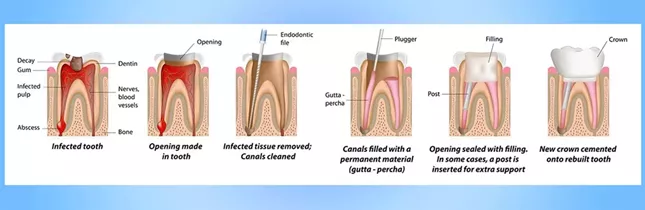 Dental examination room for post root canal symptom evaluation in Istanbul