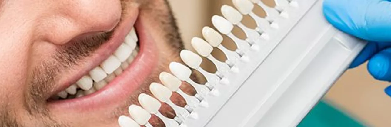 When do veneers look fake — common causes explained