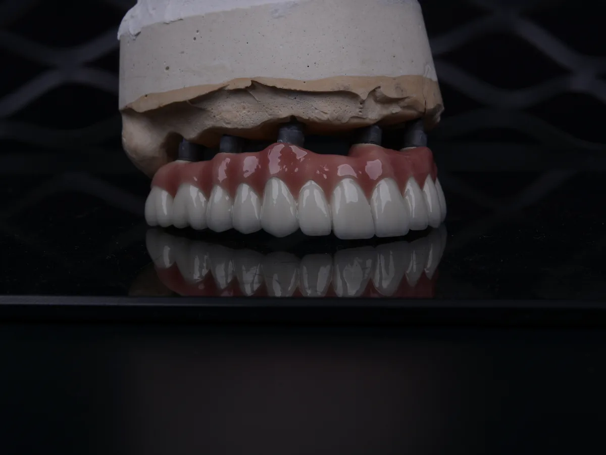All on 4 implants dentaires Istanbul – restauration complète chez CityDent