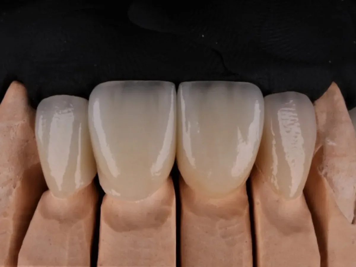 All-ceramic crown in Istanbul – natural translucency