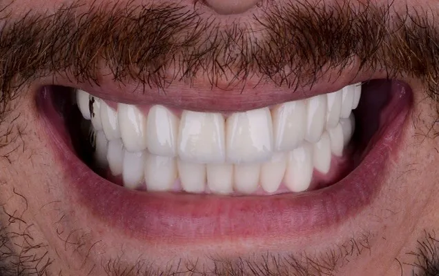 Full ceramic crown preparation – Citydent dental lab