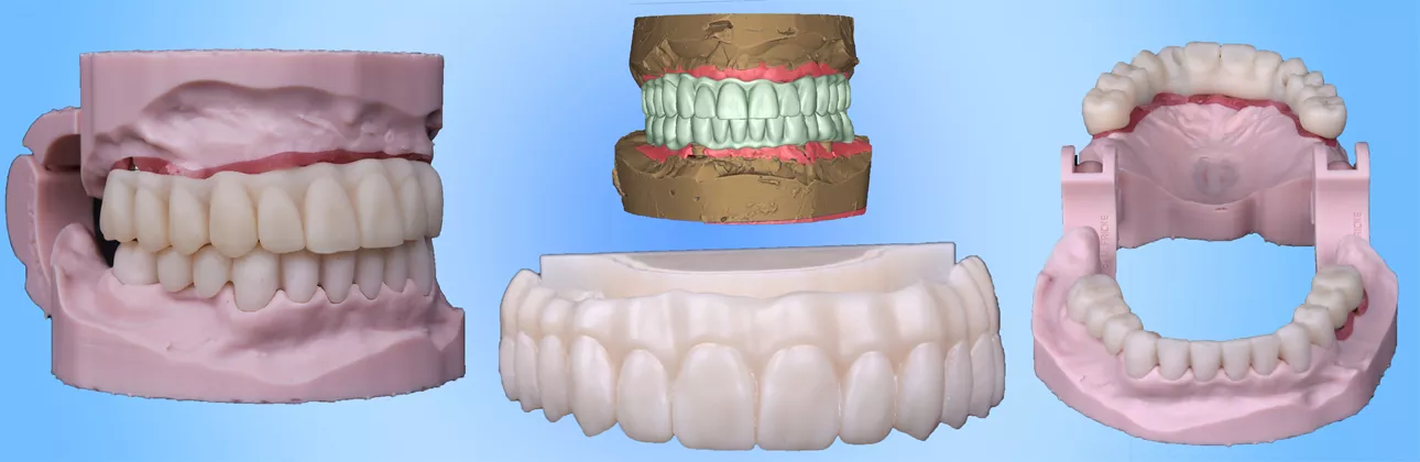 Fixed temporary tooth on dental implant — Citydent Istanbul