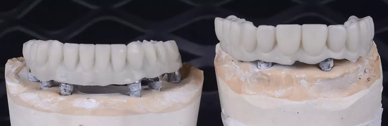 Temporary dental prosthesis problems — patient care guide at Citydent Istanbul