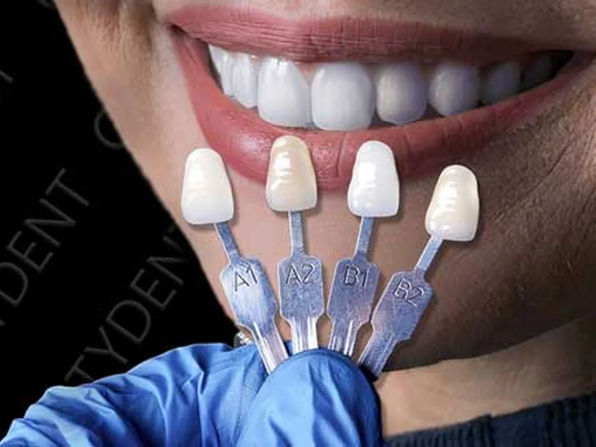 Dental shade guide showing natural tooth colours used in Istanbul