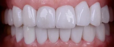 Pflege und Nachsorge der Veneers bei CityDent Istanbul