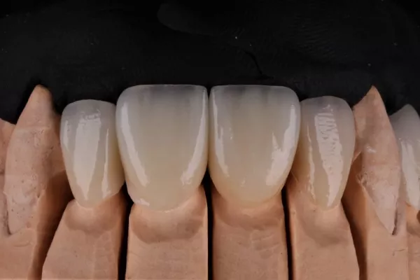 Farbwahl und Smile-Design-Planung f&uuml;r Veneers bei CityDent Istanbul