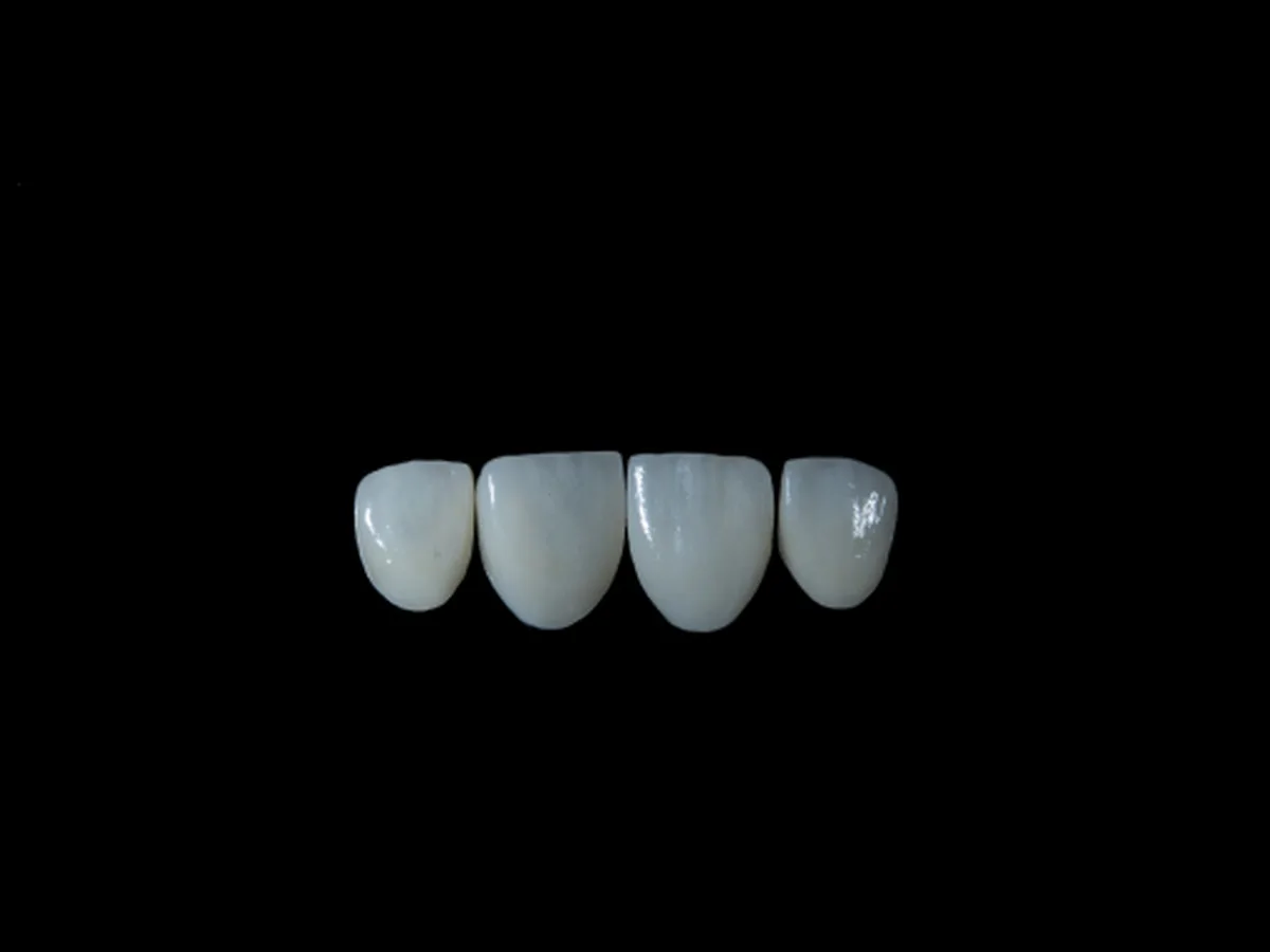 Geeignete Kandidaten f&uuml;r Veneers bei CityDent Istanbul